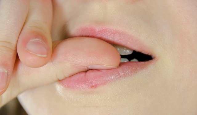 ADHD and Skin Picking