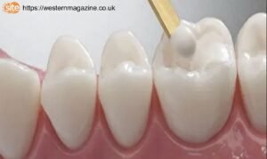 White Fillings