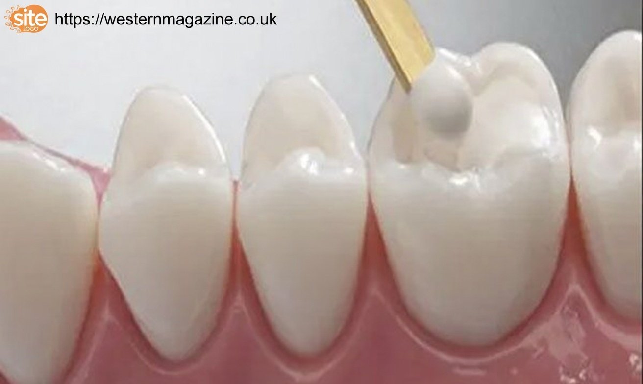 White Fillings